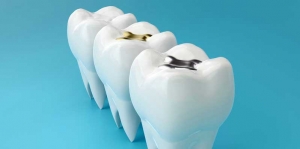 Longevity and Durability of Composite Fillings: A Comprehensive Guide